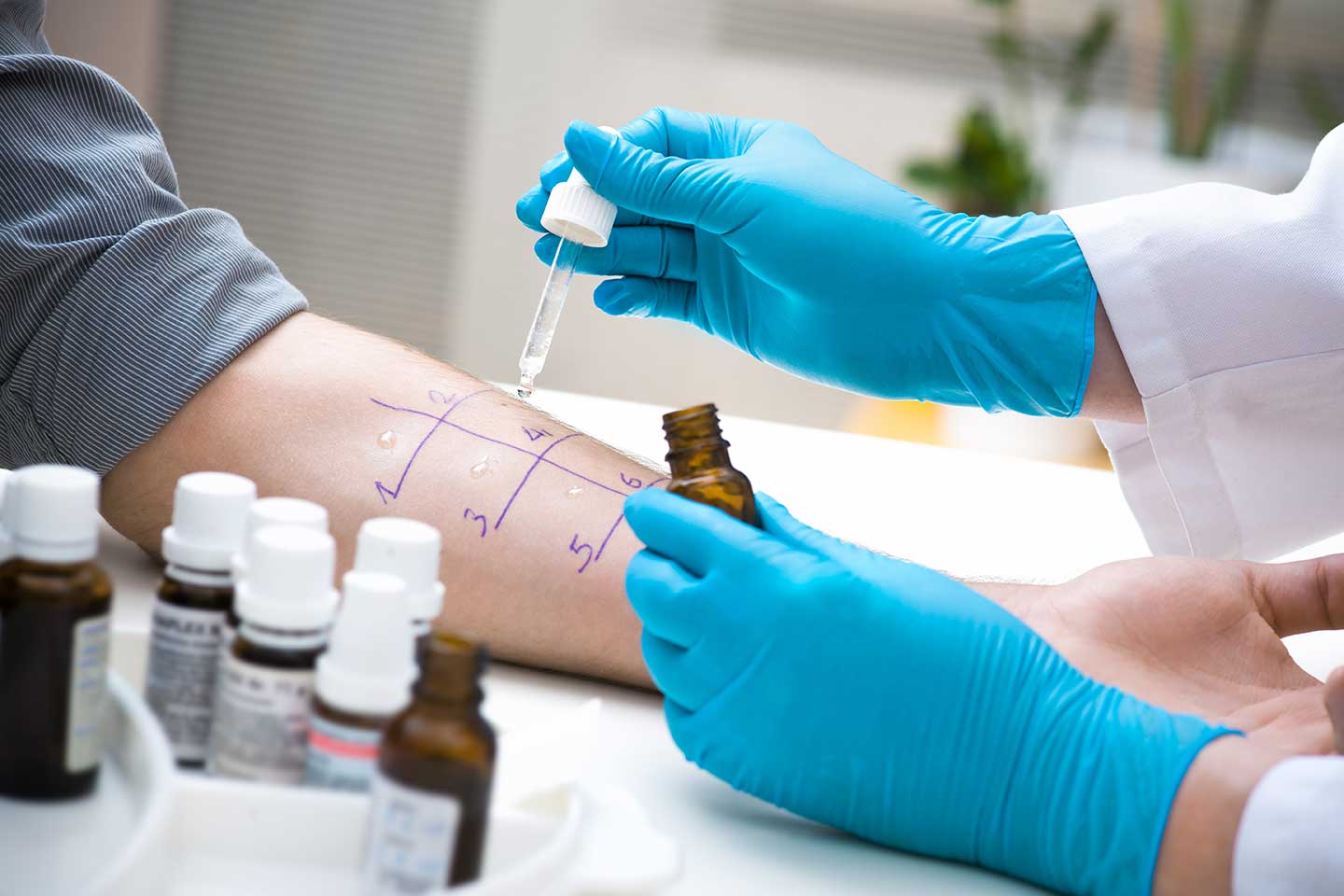 Prick test (test ubodom) - kožni test na alergiju