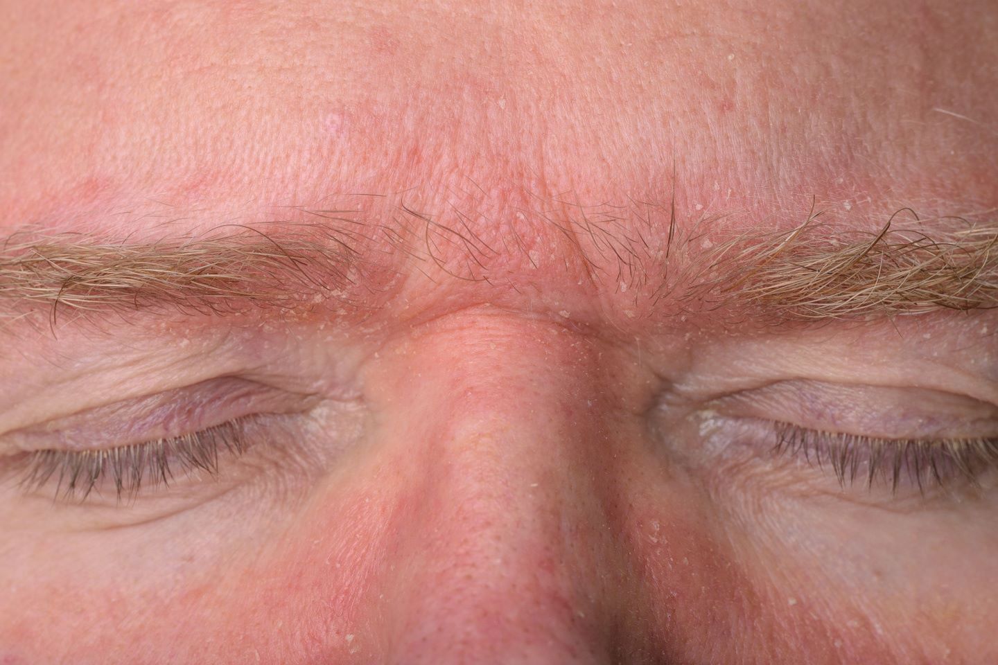 Seboroični dermatitis na obrvama i korijenu nosa
