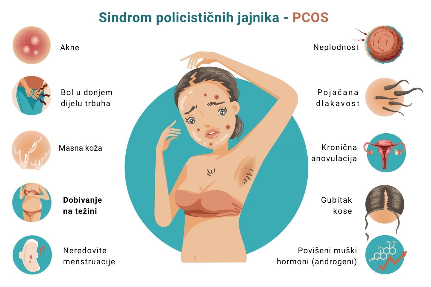 Ilustrativni prikaz simptoma sindroma policističnih jajnika (PCOS).