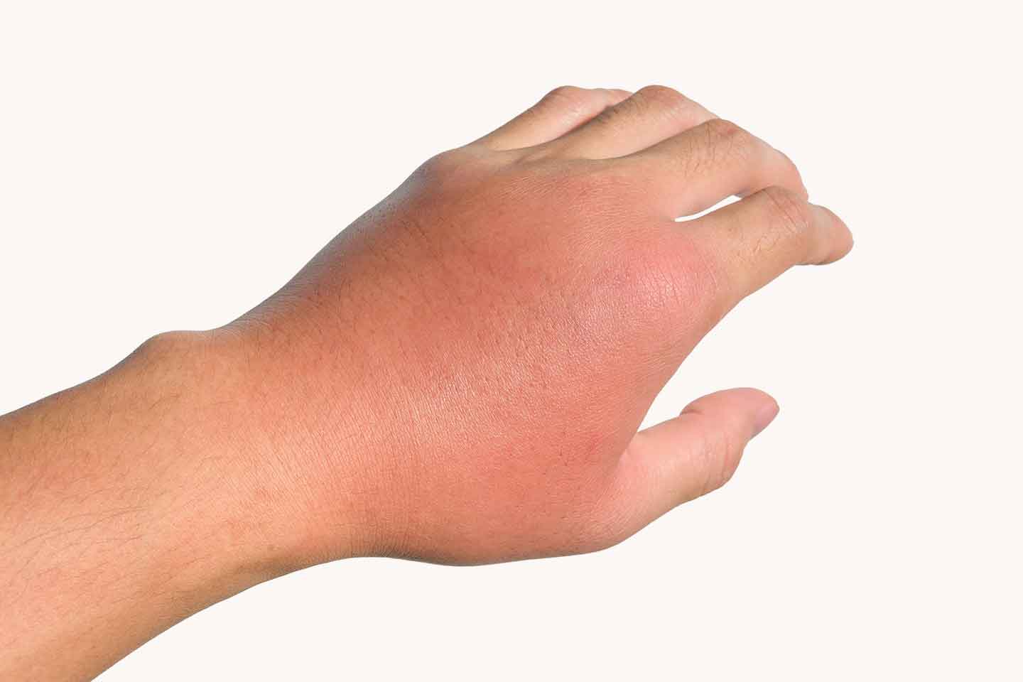Celulitis (upala potkožnog tkiva) na ruci nakon uboda insekta
