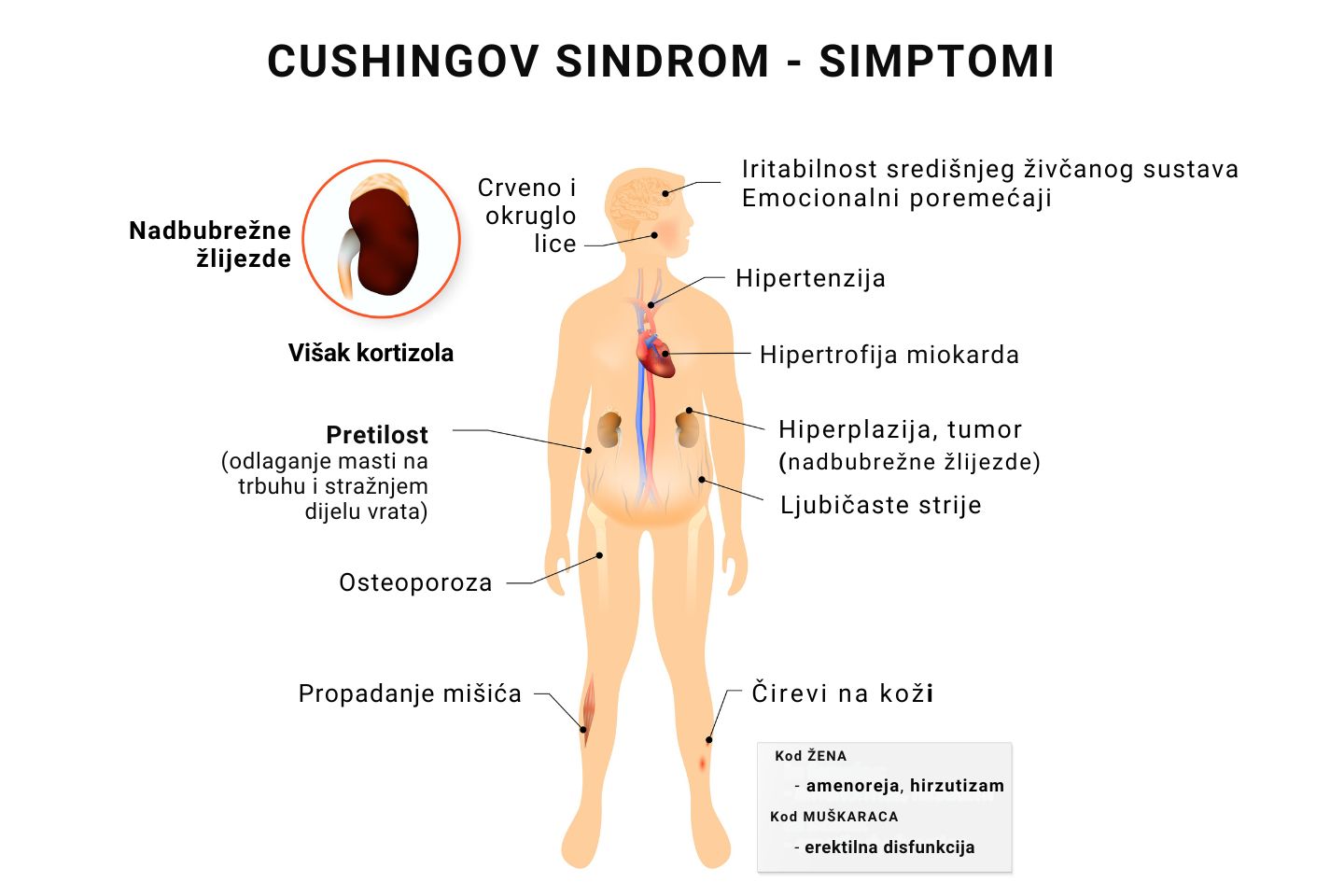 Ilustrativni prikaz simptoma Cushingovog sindroma.
