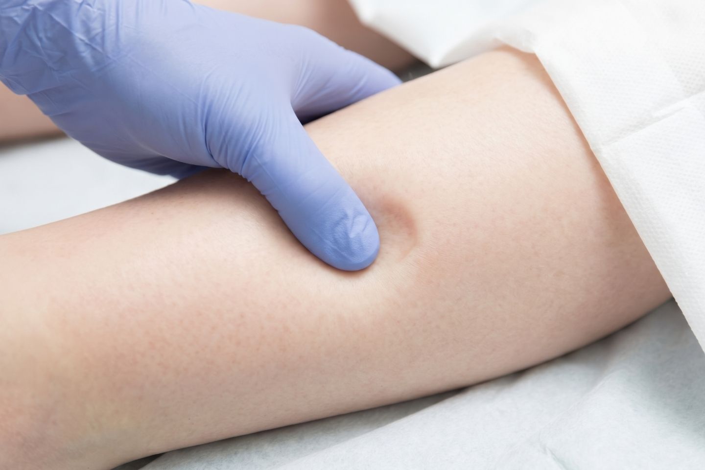 (Liječnik izvodi test udubljenja prstom u dijagnostici edema na nozi.