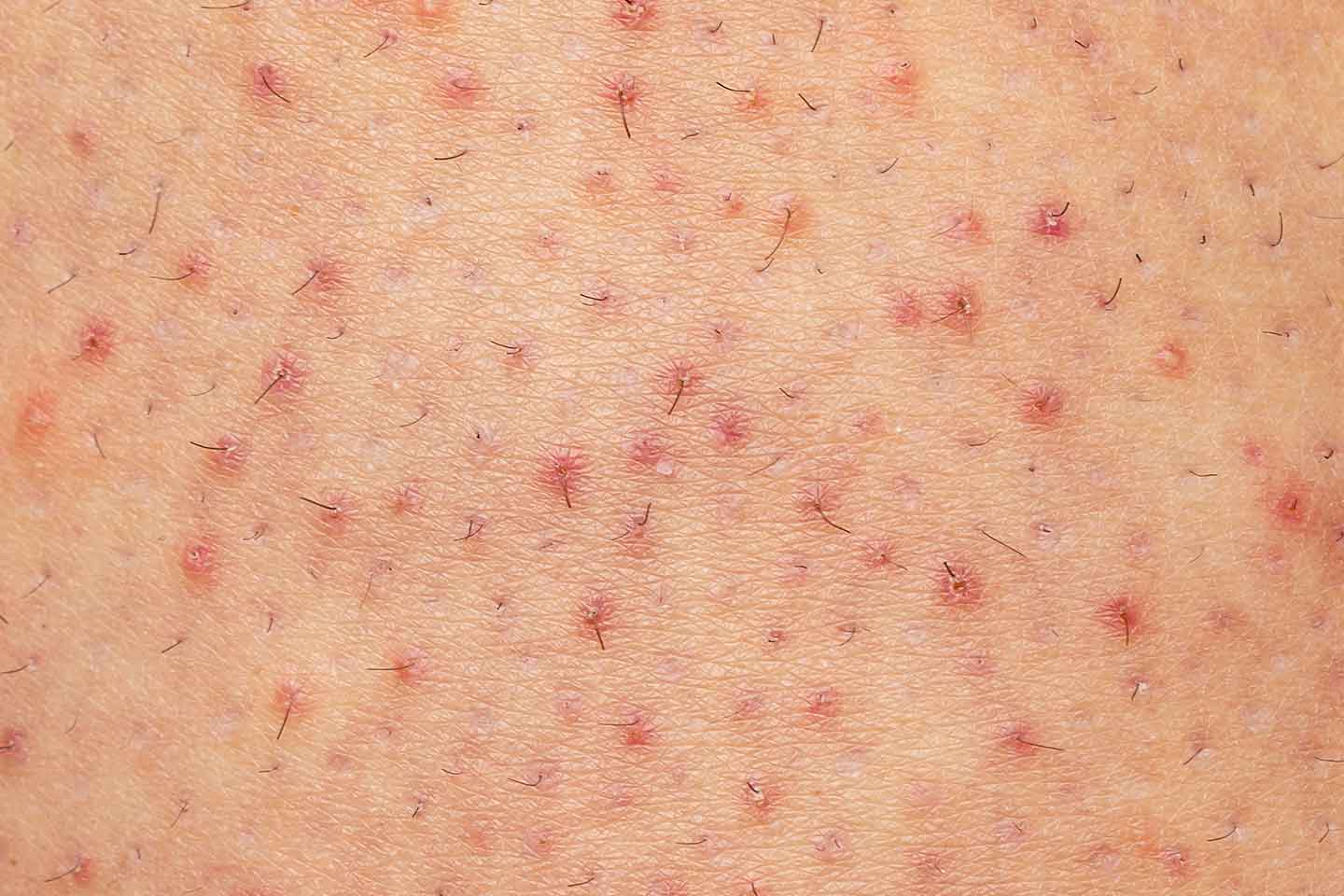 Folikulitis - upala folikula dlake