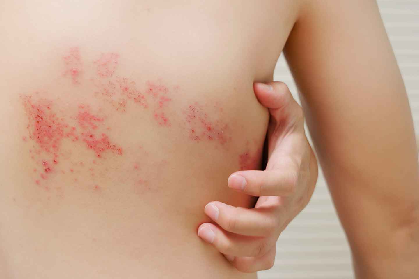 Herpes zoster