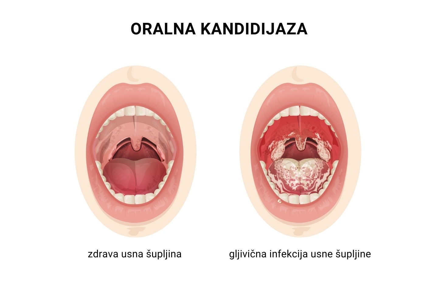 Ilustrativni prikaz razlike između zdrave usne šupljine i usne šupljine zahvaćene gljivičnom infekcijom.