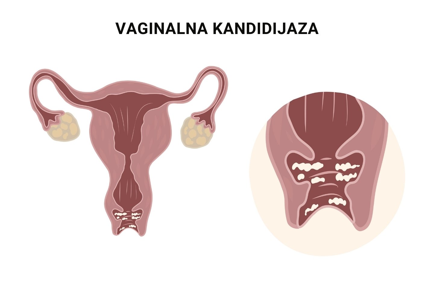 Ilustrativni prikaz vaginalne kandiidjaze.