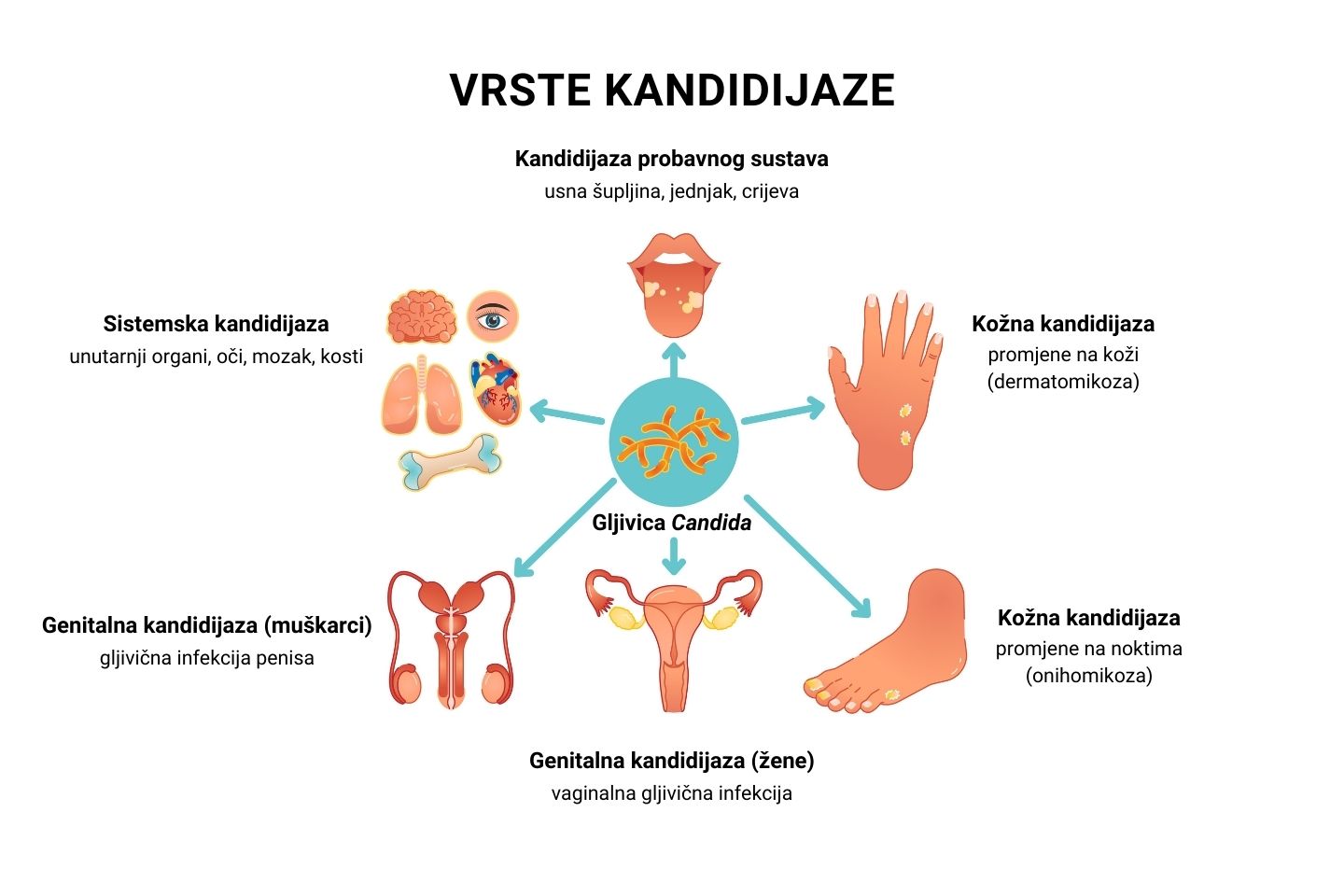 Ilustrativni prikaz vrsta kandidijaze u odnosu na lokalizaciju.