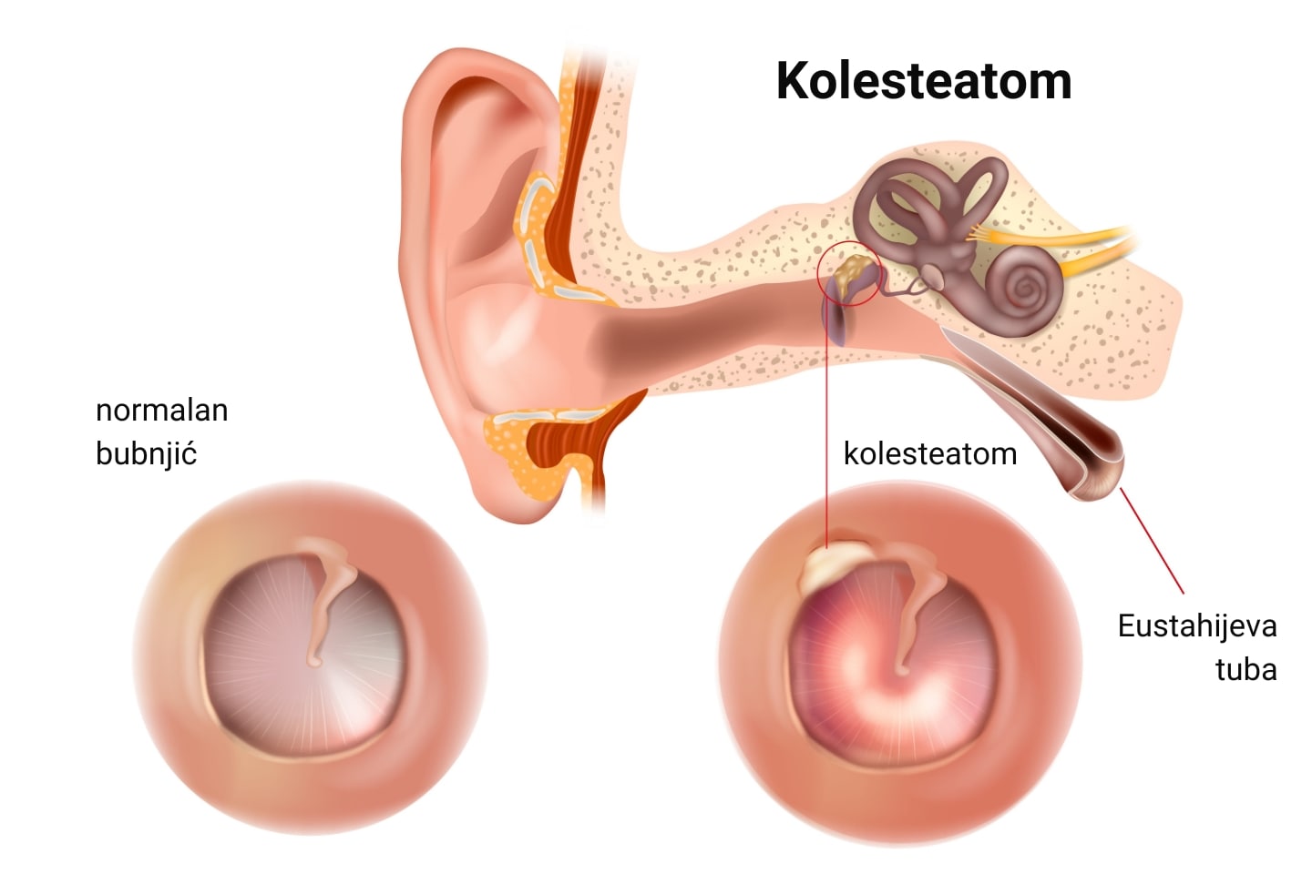 Slikovni prikaz normalnog bubnjića i bubnjića nakon razvoja kolesteatoma