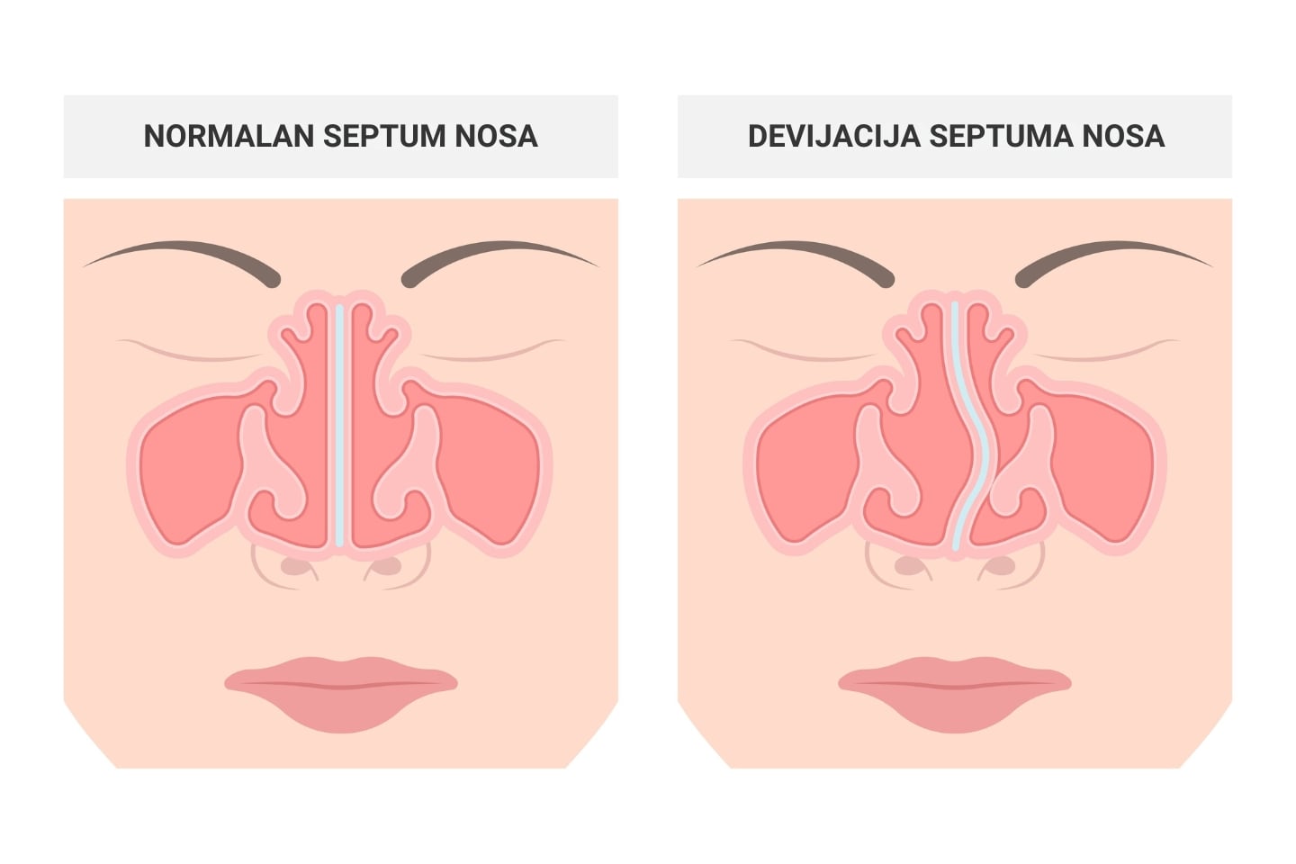 Shematski prikaz normalnog septuma i devijacije septuma