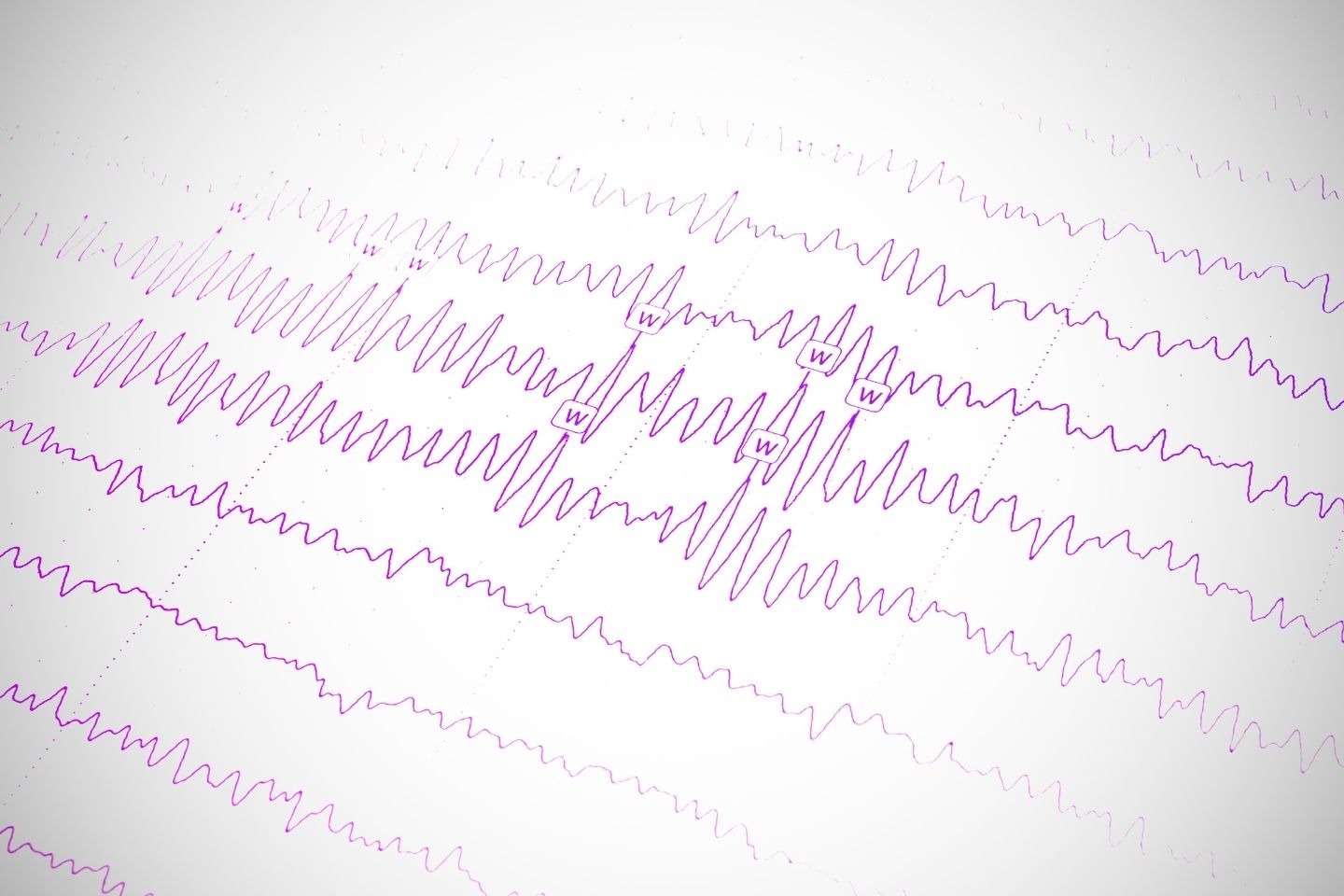 Nalaz elektroecefalografije - encefalogram.