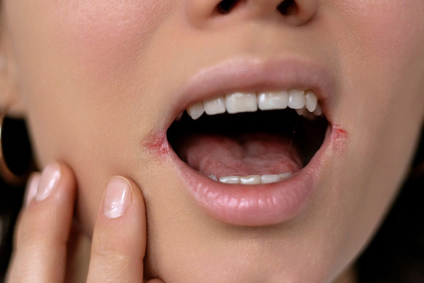 Slika žene u krupnom planu koja ima ispucale kutove usana s vidljivom iritacijom i crvenilom (angularni heilitis).